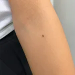 Close view of a small raised mole on a forearm.