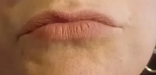 1. Labial closure before release.