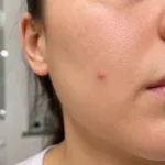 Close view of a visible pimple on a cheek.